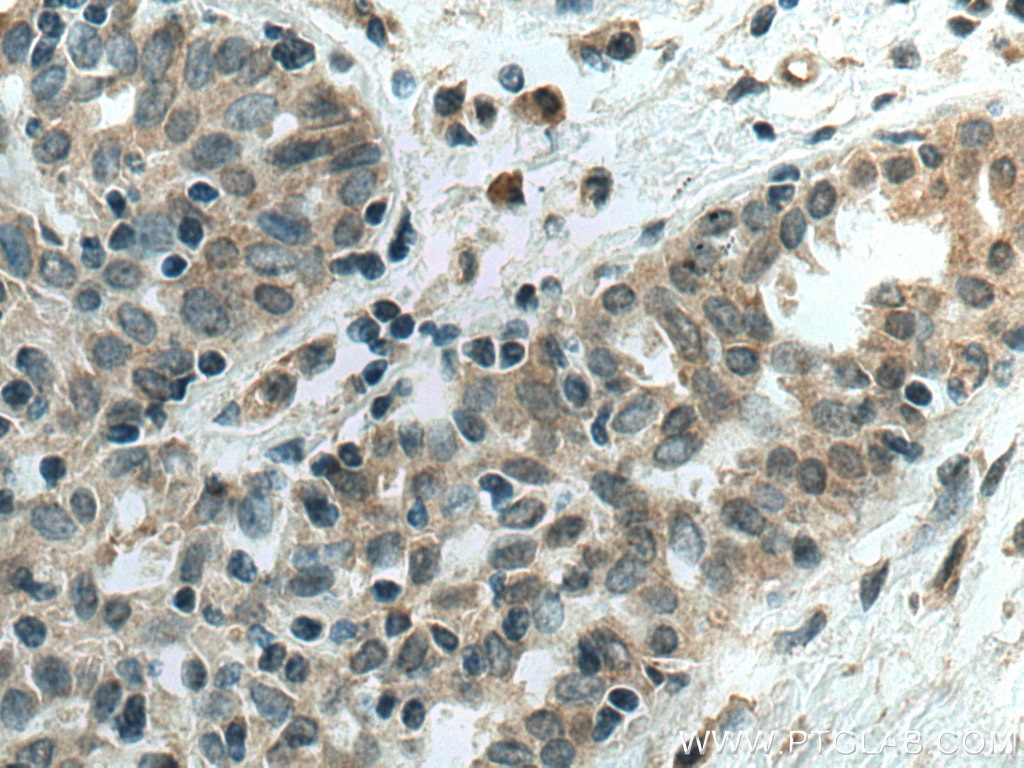 Immunohistochemistry (IHC) staining of human breast cancer tissue using AHR Monoclonal antibody (67785-1-Ig)