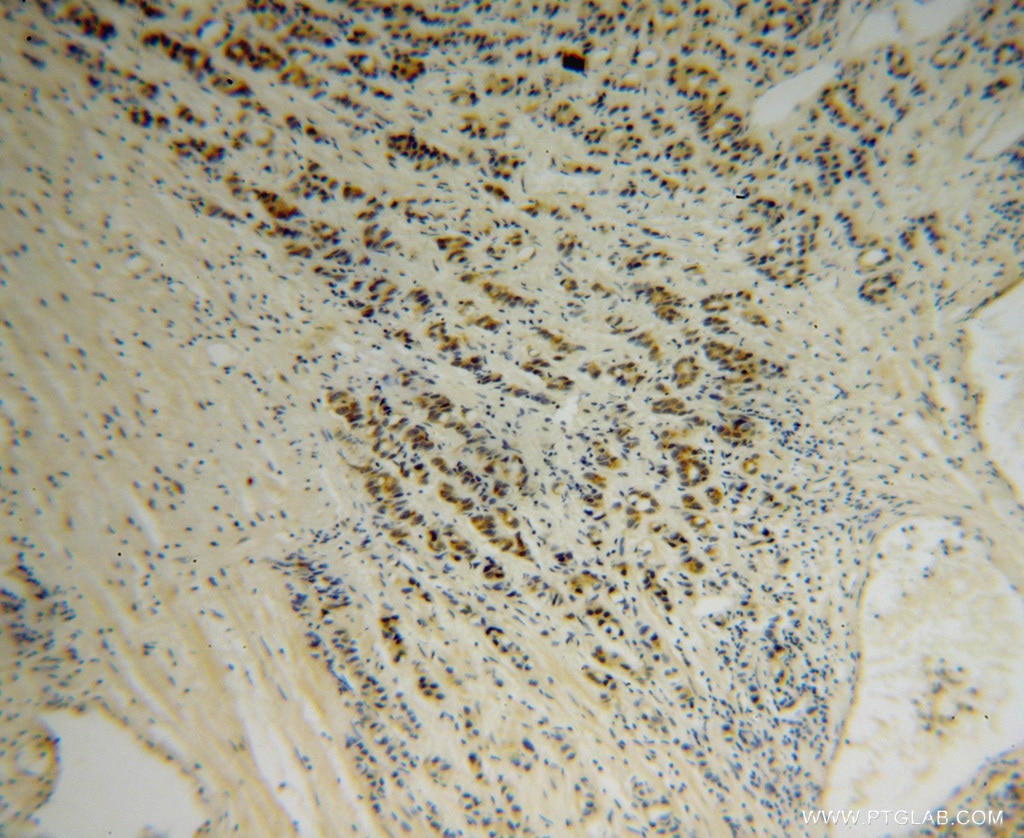 Immunohistochemistry (IHC) staining of human gliomas tissue using AHSA1 Polyclonal antibody (14725-1-AP)
