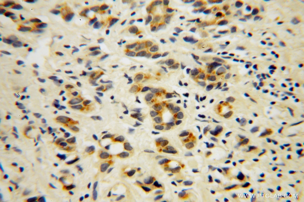 Immunohistochemistry (IHC) staining of human gliomas tissue using AHSA1 Polyclonal antibody (14725-1-AP)