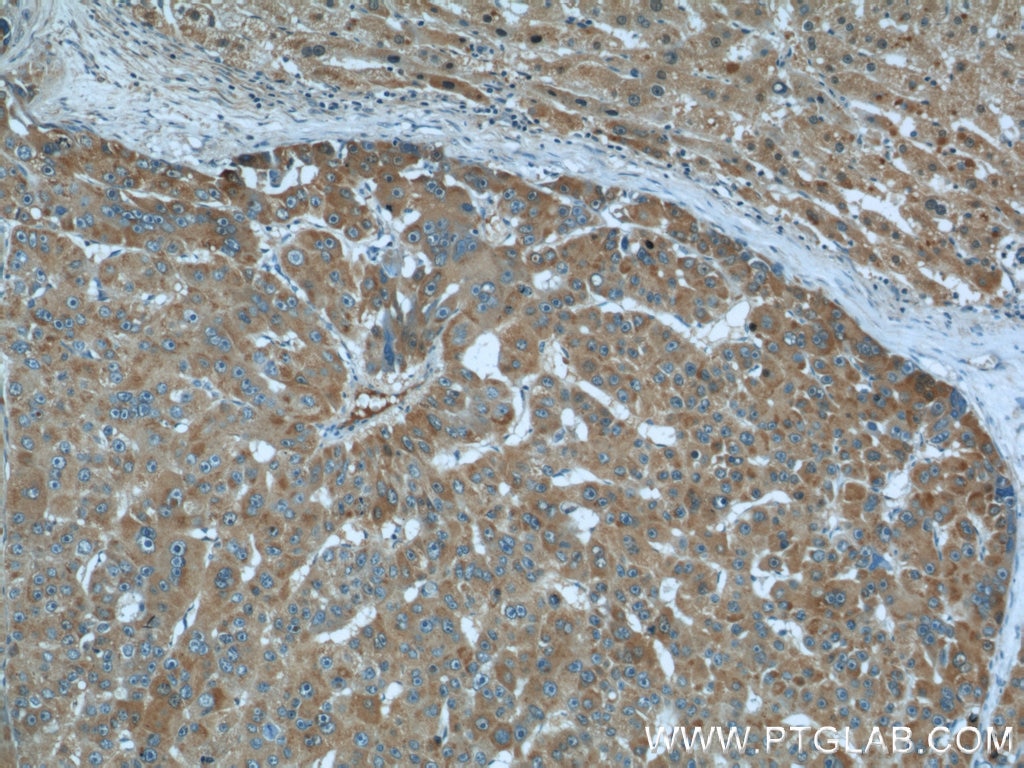 Immunohistochemistry (IHC) staining of human liver cancer tissue using Fetuin-A Monoclonal antibody (66094-1-Ig)