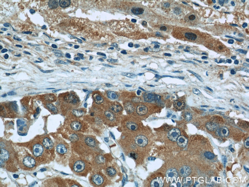 Immunohistochemistry (IHC) staining of human liver cancer tissue using Fetuin-A Monoclonal antibody (66094-1-Ig)