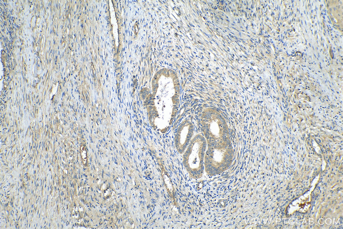Immunohistochemistry (IHC) staining of human ovary tumor tissue using AIFM3 Polyclonal antibody (14778-1-AP)