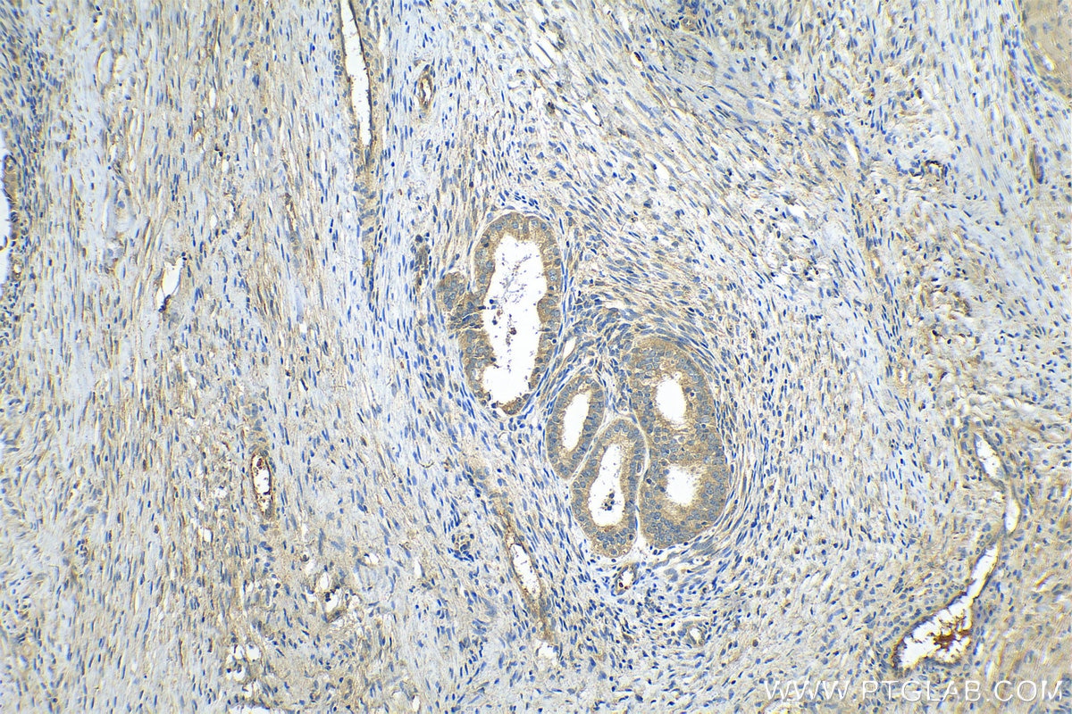 IHC staining of human ovary tumor using 14778-1-AP