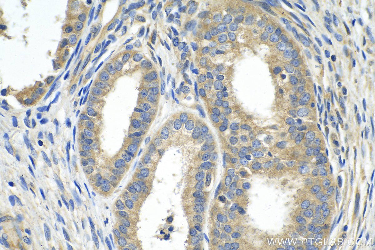 Immunohistochemistry (IHC) staining of human ovary tumor tissue using AIFM3 Polyclonal antibody (14778-1-AP)