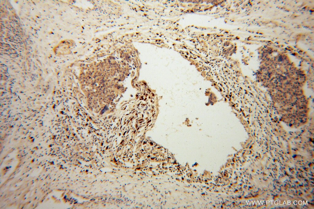 IHC staining of human ovary tumor using 14468-1-AP