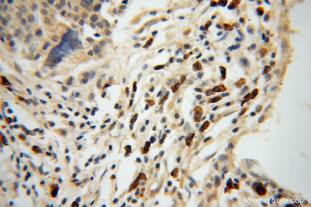 Immunohistochemistry (IHC) staining of human ovary tumor tissue using AIG1 Polyclonal antibody (14468-1-AP)