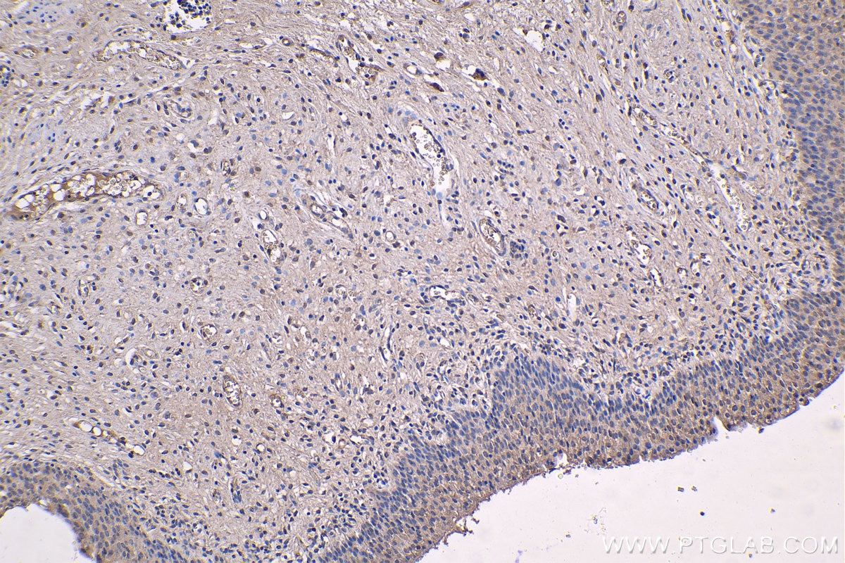 Immunohistochemistry (IHC) staining of human urothelial carcinoma tissue using AIM2 Monoclonal antibody (66902-1-Ig)