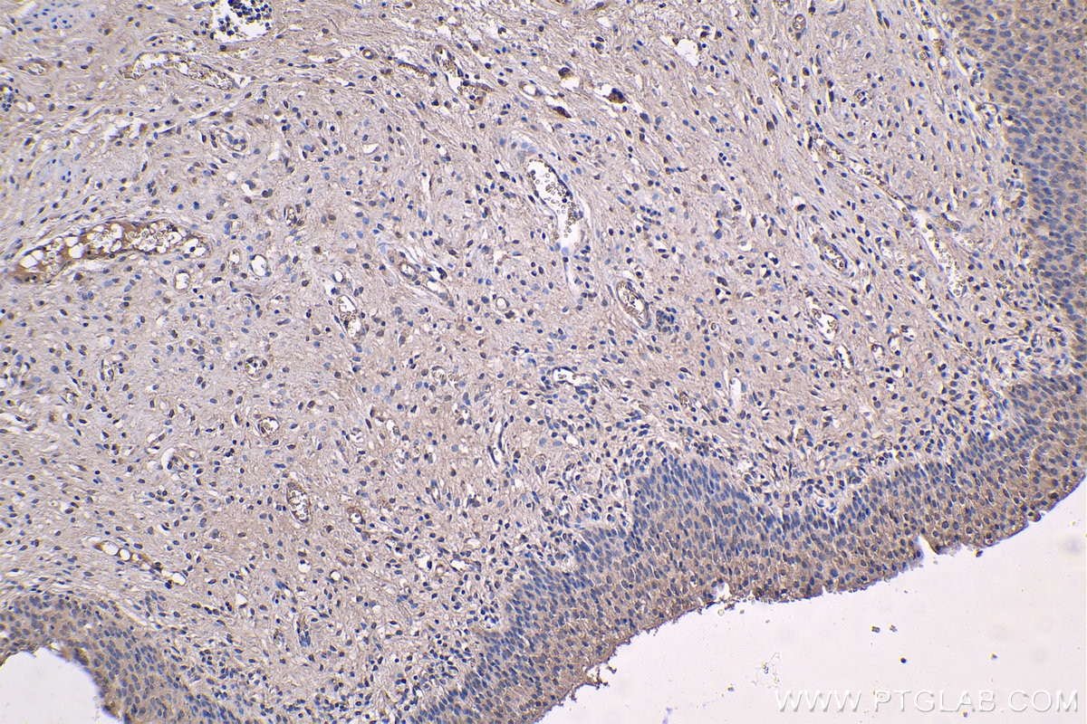 IHC staining of human urothelial carcinoma using 66902-1-Ig