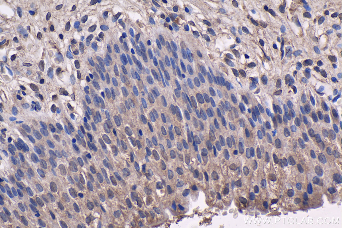 Immunohistochemistry (IHC) staining of human urothelial carcinoma tissue using AIM2 Monoclonal antibody (66902-1-Ig)
