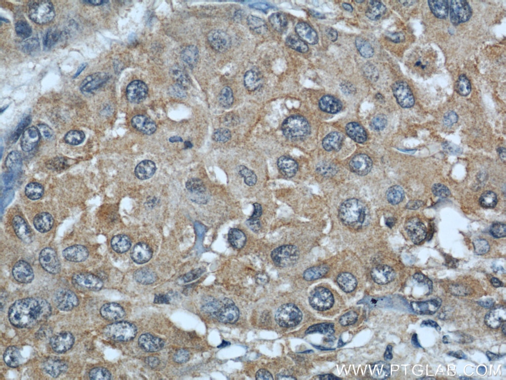 Immunohistochemistry (IHC) staining of human liver cancer tissue using AIP/ARA9 Polyclonal antibody (18176-1-AP)