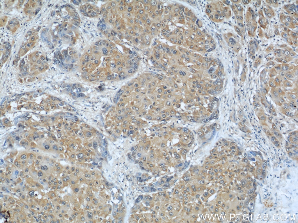 Immunohistochemistry (IHC) staining of human liver cancer tissue using AIP/ARA9 Polyclonal antibody (18176-1-AP)