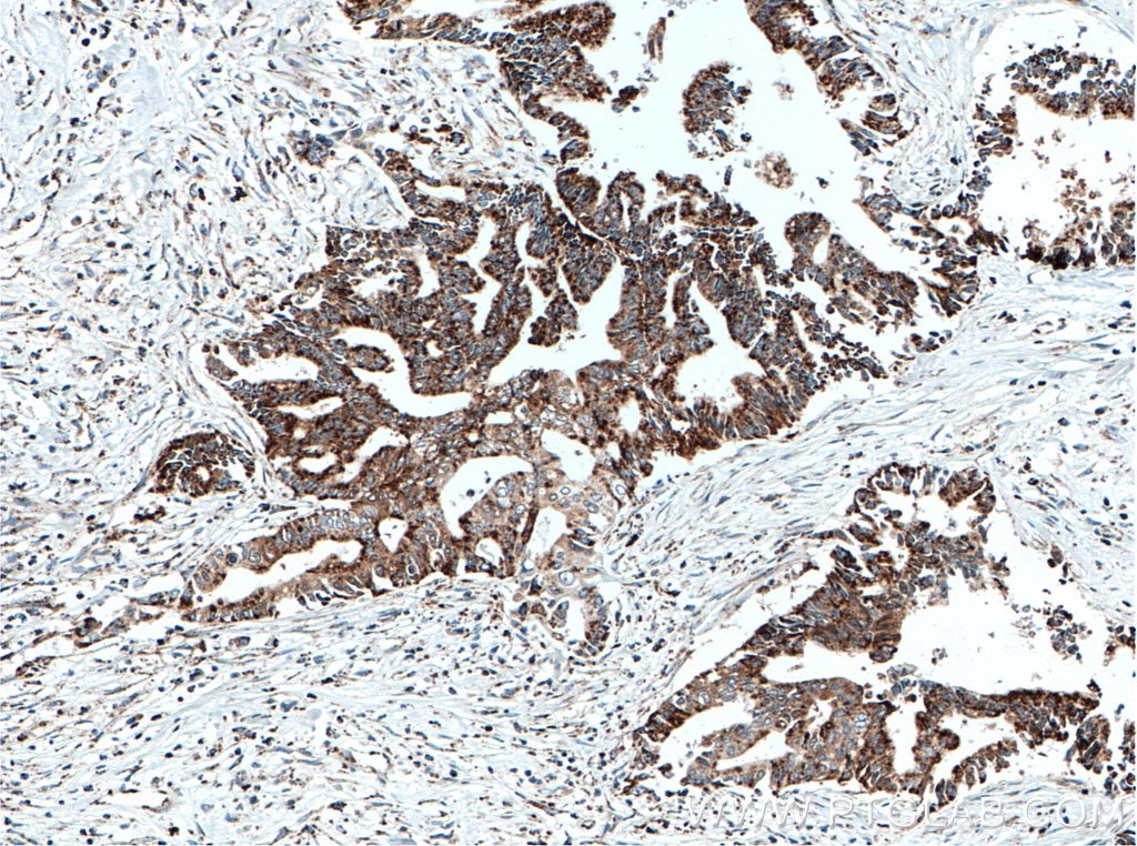 IHC staining of human pancreas cancer using 11014-1-AP