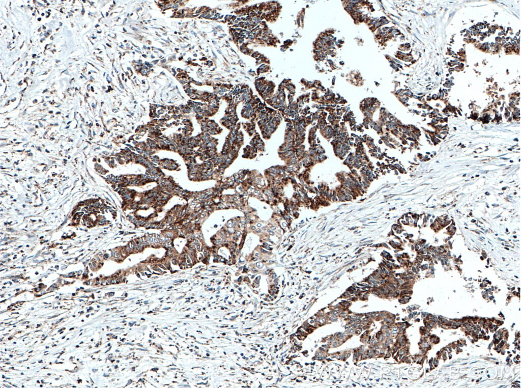 Immunohistochemistry (IHC) staining of human pancreas cancer tissue using AK2 Polyclonal antibody (11014-1-AP)