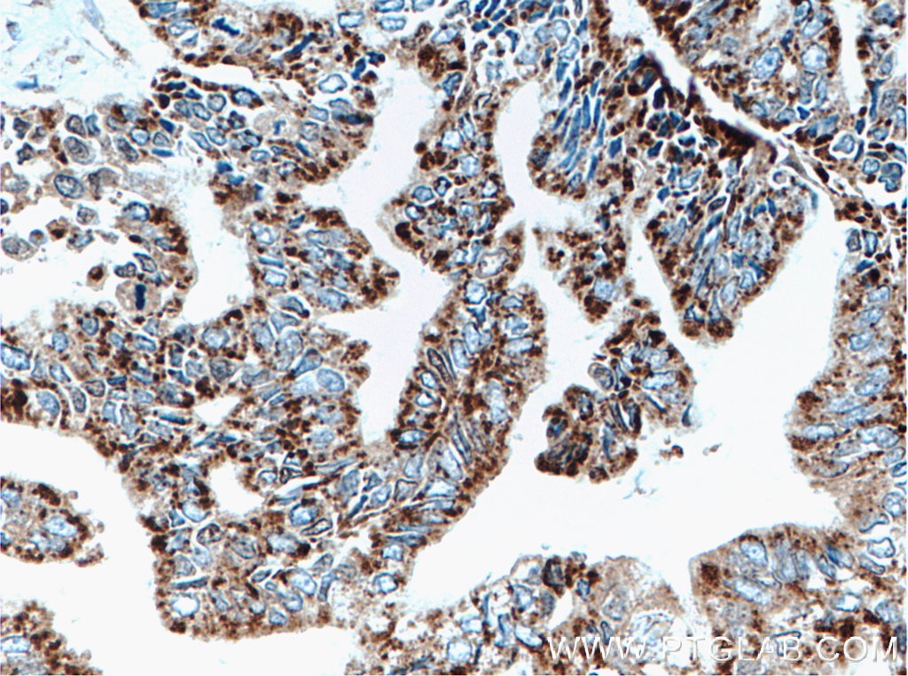 Immunohistochemistry (IHC) staining of human pancreas cancer tissue using AK2 Polyclonal antibody (11014-1-AP)