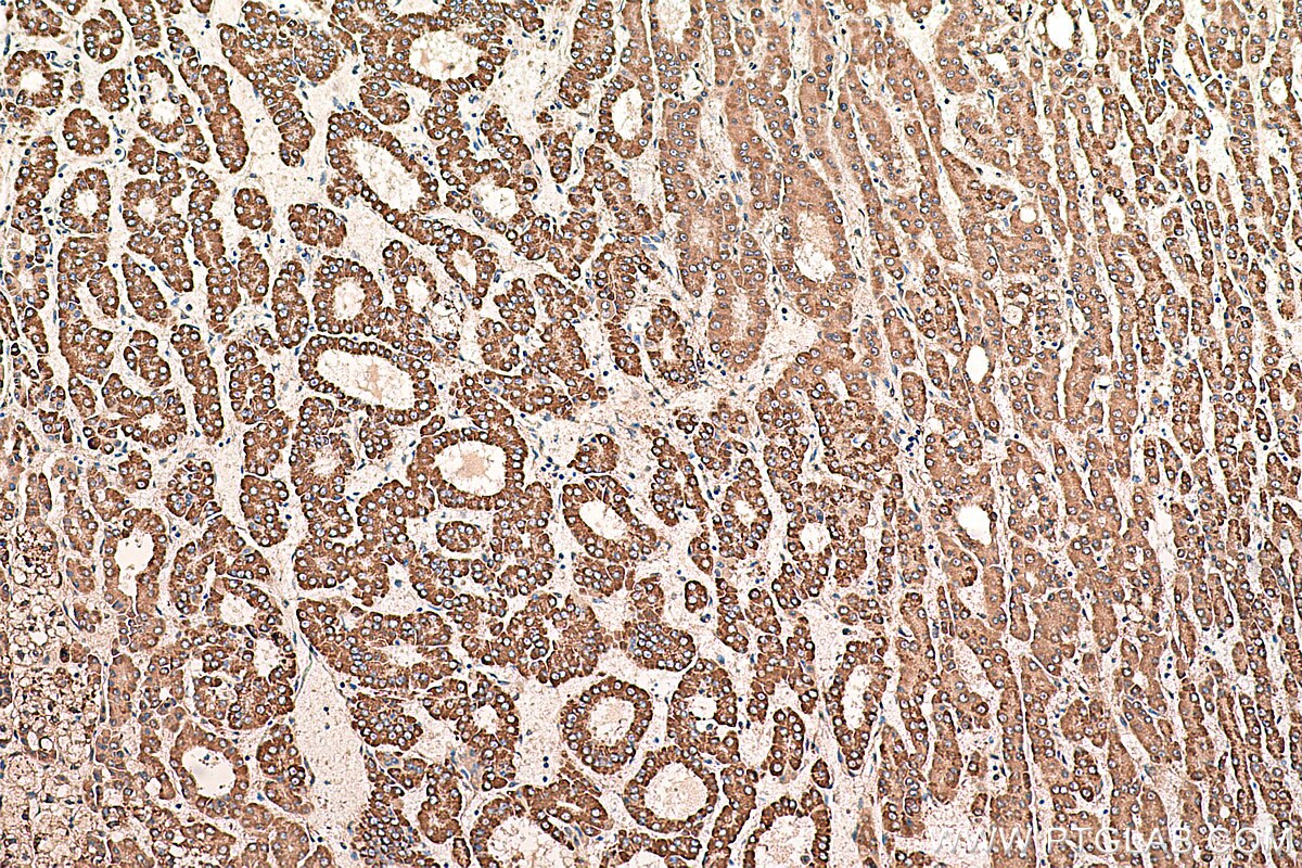Immunohistochemistry (IHC) staining of human liver cancer tissue using AK2 Monoclonal antibody (66127-1-Ig)
