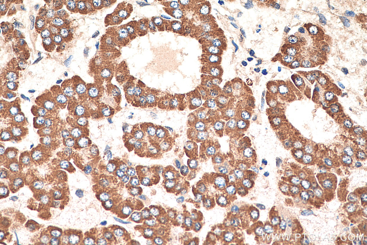Immunohistochemistry (IHC) staining of human liver cancer tissue using AK2 Monoclonal antibody (66127-1-Ig)
