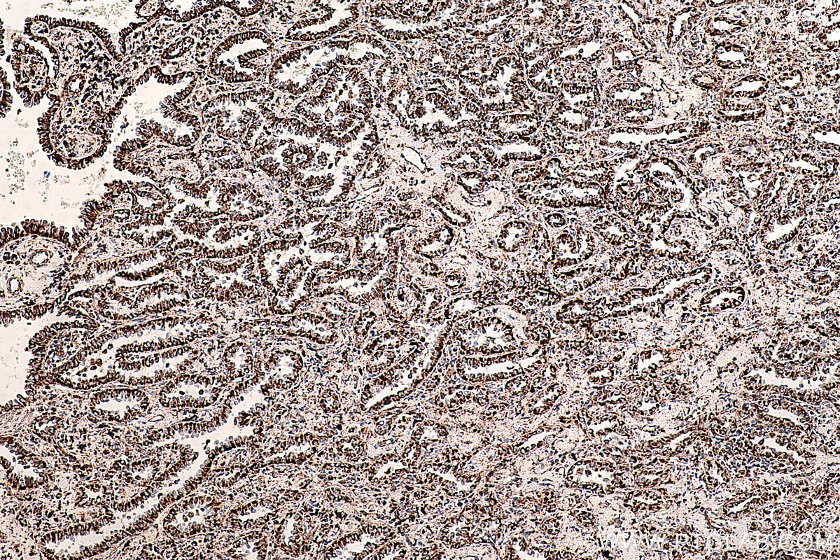 Immunohistochemistry (IHC) staining of human lung cancer tissue using AK2 Monoclonal antibody (66127-1-Ig)