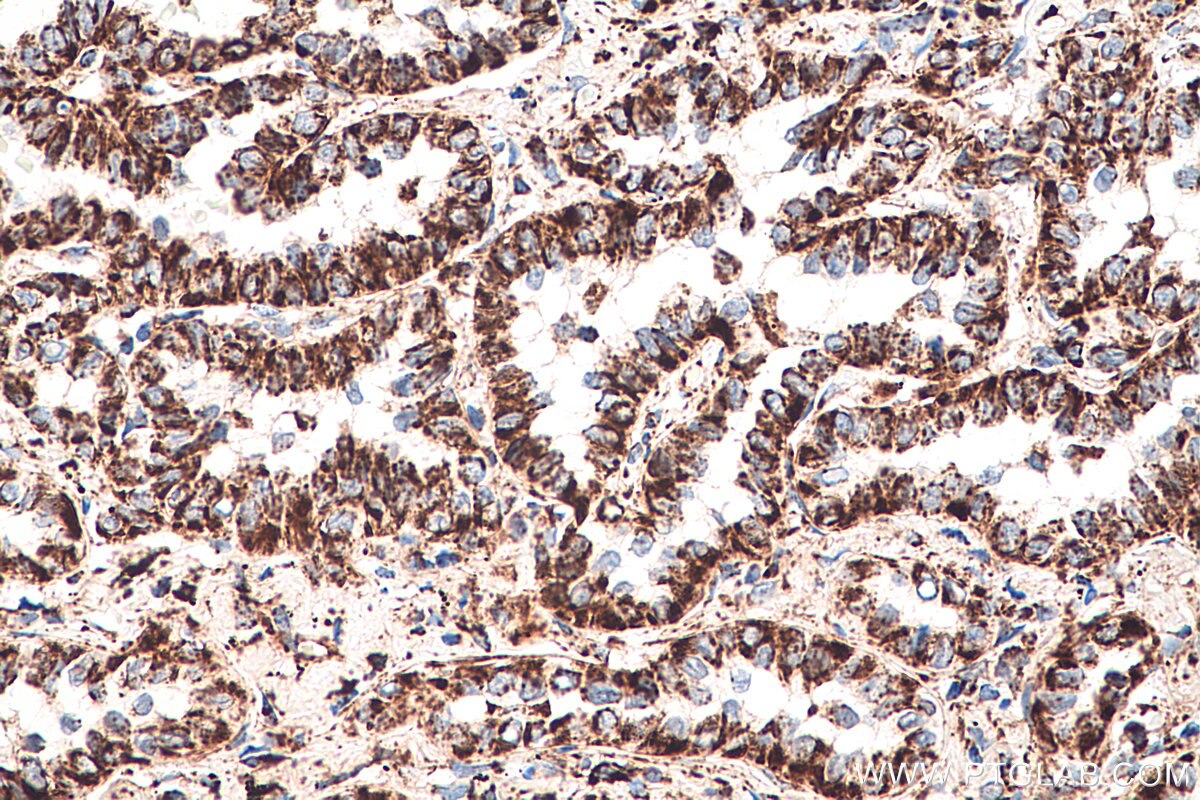 Immunohistochemistry (IHC) staining of human lung cancer tissue using AK2 Monoclonal antibody (66127-1-Ig)