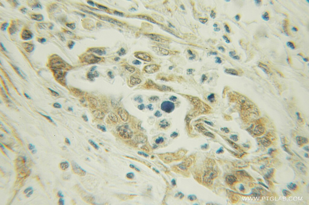 Immunohistochemistry (IHC) staining of human pancreas cancer tissue using AK3 Polyclonal antibody (12562-1-AP)