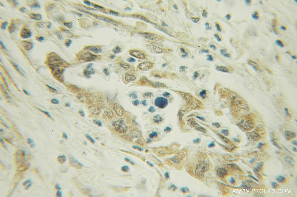 IHC staining of human pancreas cancer using 12562-1-AP