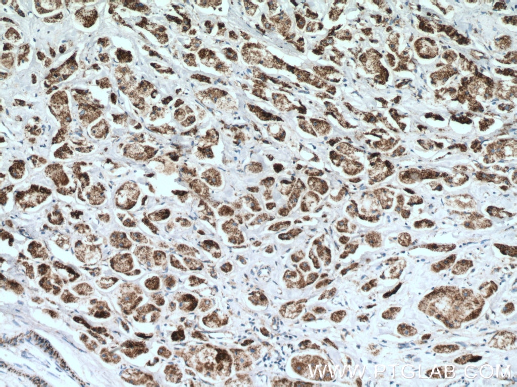 Immunohistochemistry (IHC) staining of human breast cancer tissue using AK3L1 Polyclonal antibody (13206-1-AP)