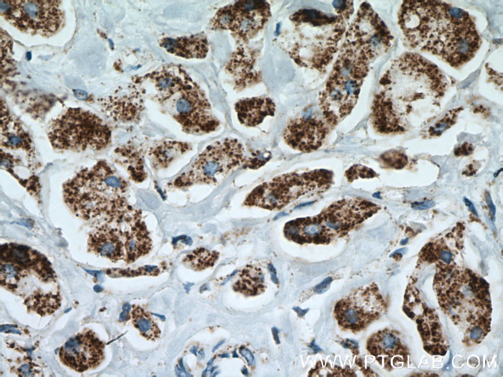 Immunohistochemistry (IHC) staining of human breast cancer tissue using AK3L1 Polyclonal antibody (13206-1-AP)