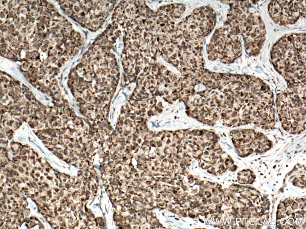 Immunohistochemistry (IHC) staining of human lung cancer tissue using AKAP1 Polyclonal antibody (15618-1-AP)