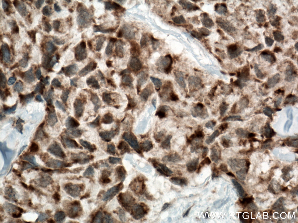 Immunohistochemistry (IHC) staining of human lung cancer tissue using AKAP1 Polyclonal antibody (15618-1-AP)
