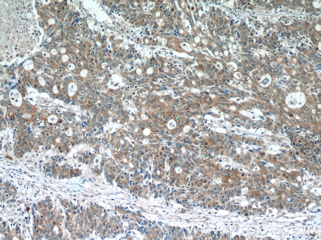 Immunohistochemistry (IHC) staining of human colon cancer tissue using AKAP1 Polyclonal antibody (15618-1-AP)
