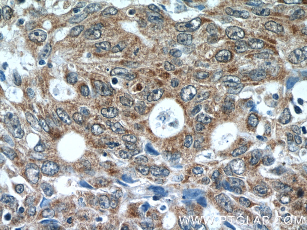 Immunohistochemistry (IHC) staining of human colon cancer tissue using AKAP1 Polyclonal antibody (15618-1-AP)