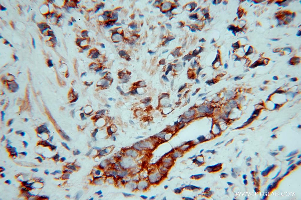 Immunohistochemistry (IHC) staining of human prostate cancer tissue using AKAP1 Polyclonal antibody (15618-1-AP)