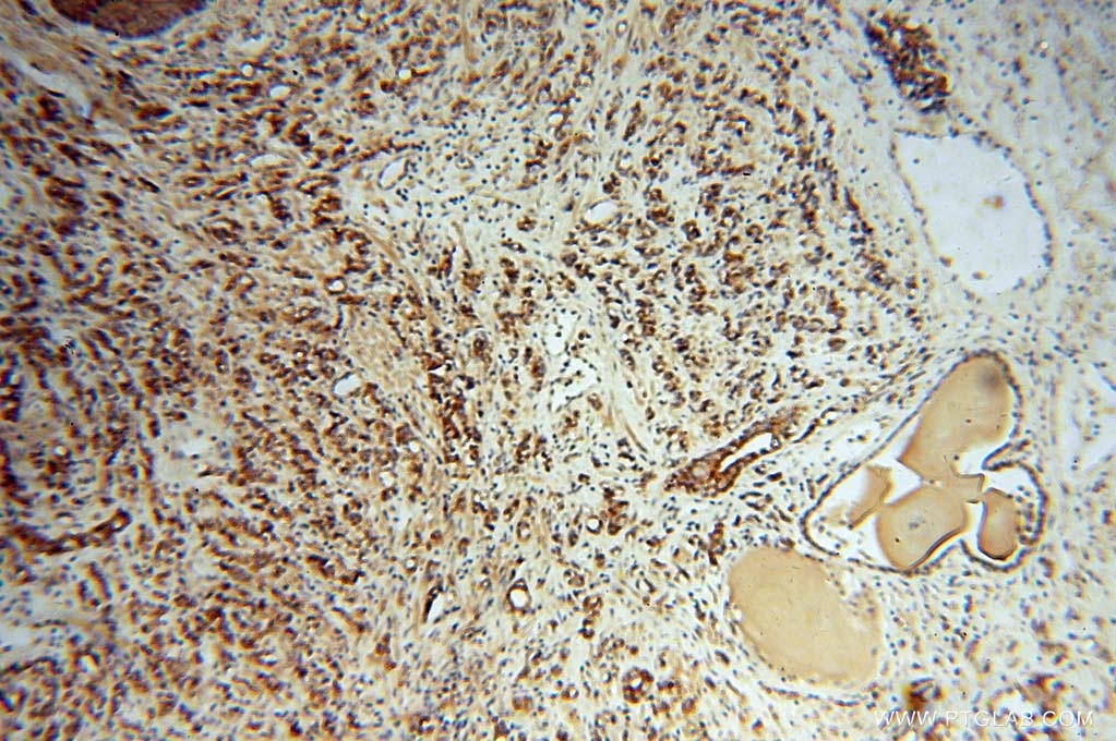 Immunohistochemistry (IHC) staining of human prostate cancer tissue using AKAP1 Polyclonal antibody (15618-1-AP)