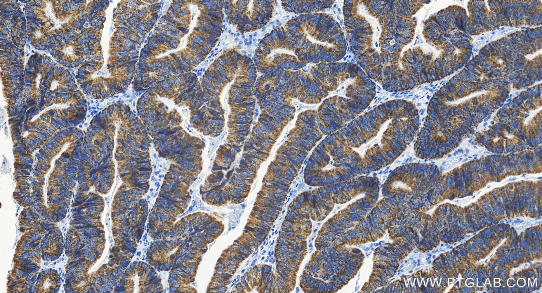 Immunohistochemistry (IHC) staining of human colon cancer tissue using AKAP1 Recombinant antibody (85119-2-RR)