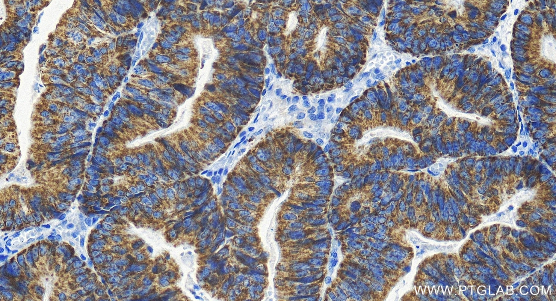 Immunohistochemistry (IHC) staining of human colon cancer tissue using AKAP1 Recombinant antibody (85119-2-RR)