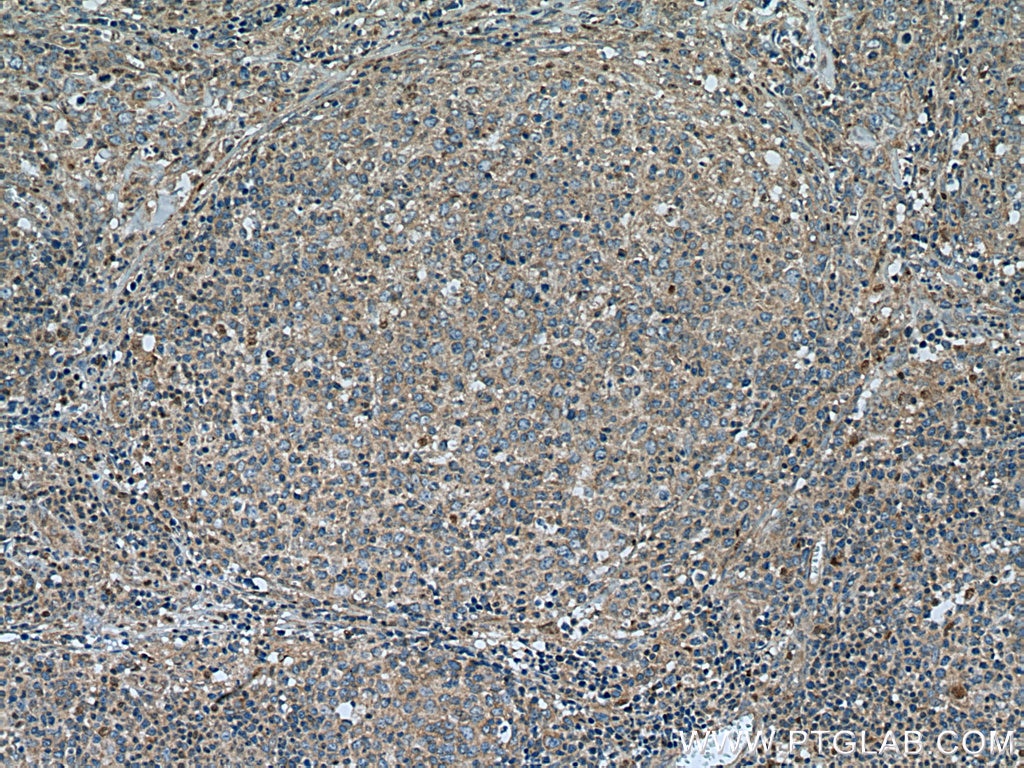 Immunohistochemistry (IHC) staining of human lymphoma tissue using AKAP10 Polyclonal antibody (12356-1-AP)