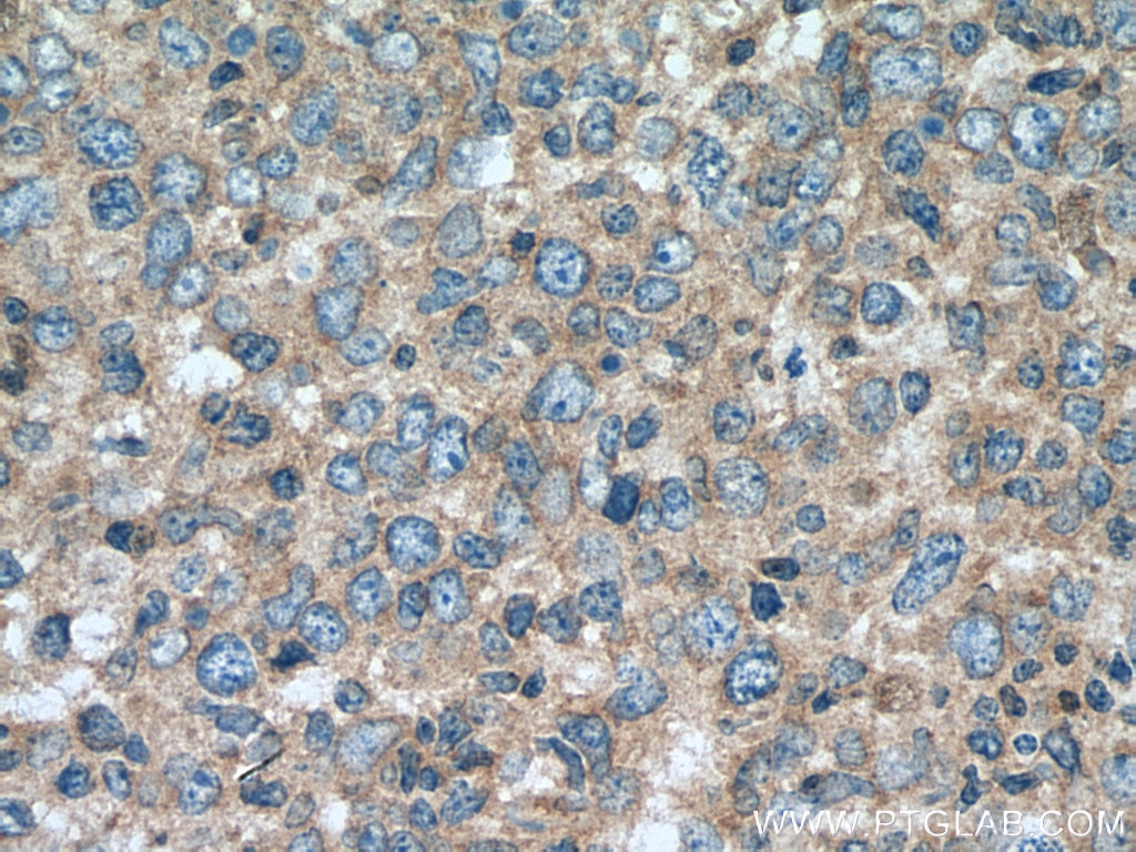 Immunohistochemistry (IHC) staining of human lymphoma tissue using AKAP10 Polyclonal antibody (12356-1-AP)