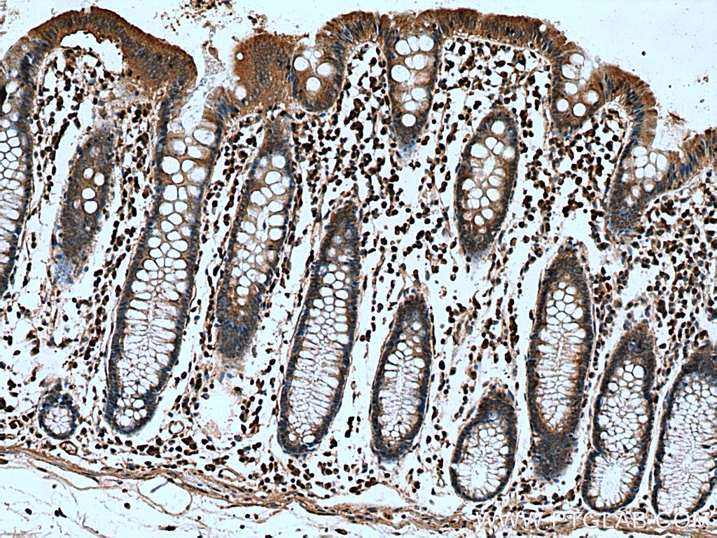 Immunohistochemistry (IHC) staining of human colon cancer tissue using AKAP10 Polyclonal antibody (12356-1-AP)