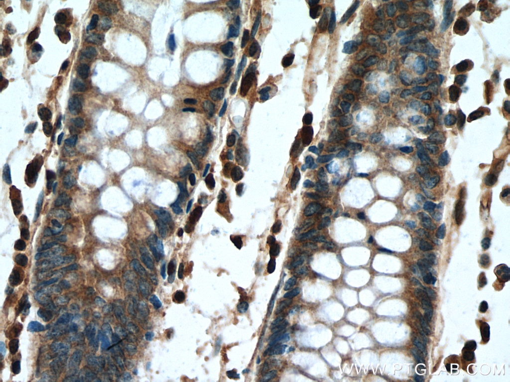 IHC staining of human colon cancer using 12356-1-AP