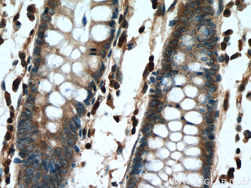 Immunohistochemistry (IHC) staining of human colon cancer tissue using AKAP10 Polyclonal antibody (12356-1-AP)