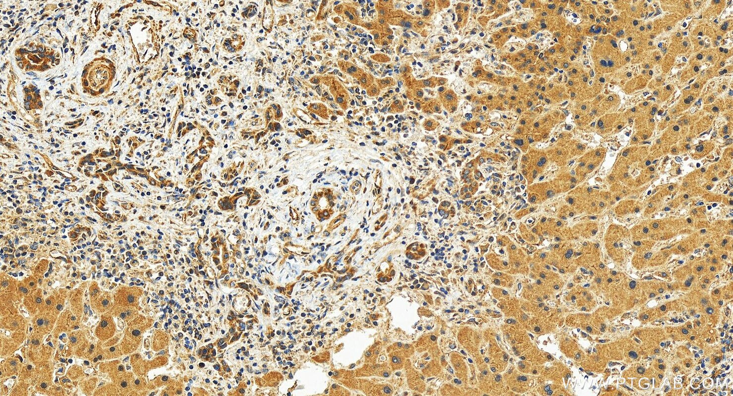 Immunohistochemistry (IHC) staining of human intrahepatic cholangiocarcinoma tissue using AKAP11-Specific Polyclonal antibody (30552-1-AP)