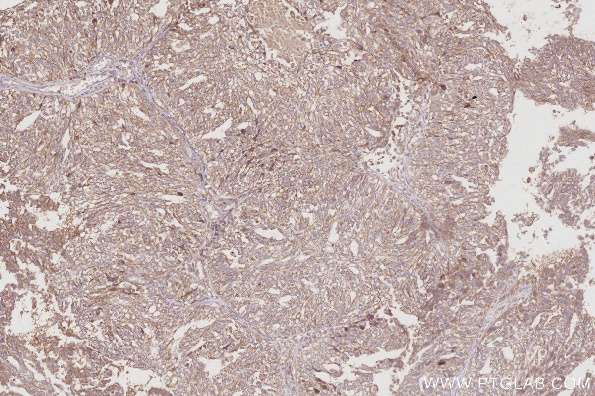 IHC staining of human ovary cancer using 30552-1-AP Immunohistochemistry (IHC) staining of human ovary cancer tissue using AKAP11-Specific Polyclonal antibody (30552-1-AP)