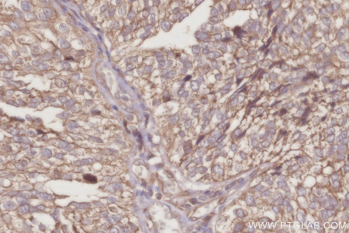 IHC staining of human ovary cancer using 30552-1-AP (same clone as 30552-1-PBS) Immunohistochemistry (IHC) staining of human ovary cancer tissue using AKAP11-Specific Polyclonal antibody (30552-1-AP)