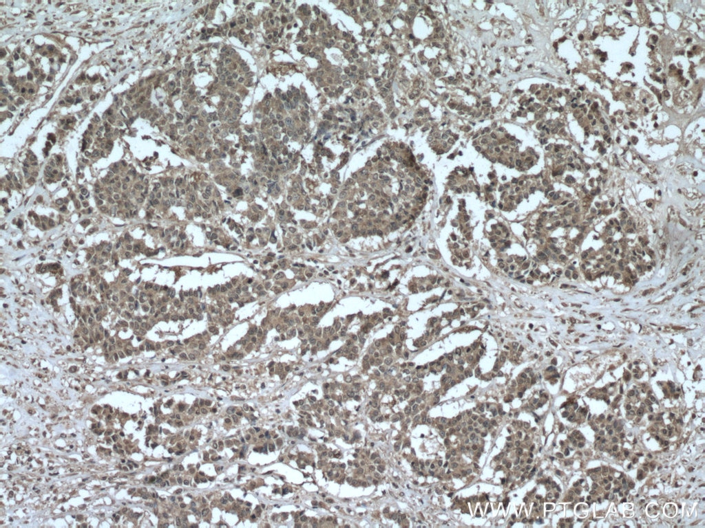 Immunohistochemistry (IHC) staining of human colon cancer tissue using AKAP13 Polyclonal antibody (27947-1-AP)