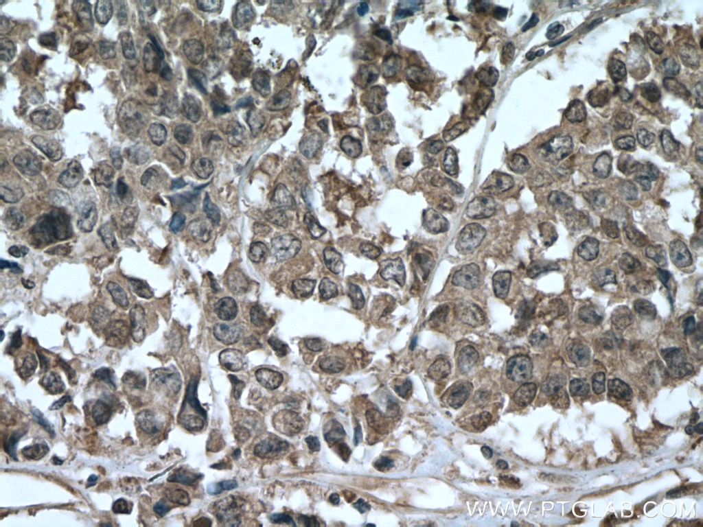 Immunohistochemistry (IHC) staining of human colon cancer tissue using AKAP13 Polyclonal antibody (27947-1-AP)