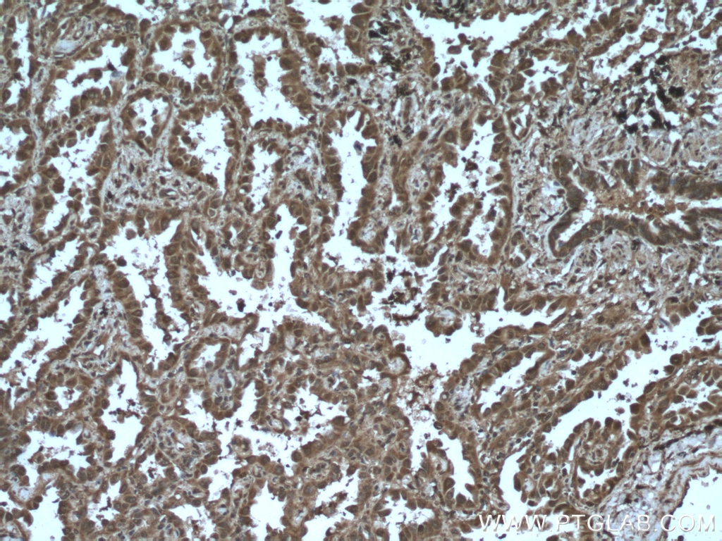 Immunohistochemistry (IHC) staining of human lung cancer tissue using AKAP13 Polyclonal antibody (27947-1-AP)