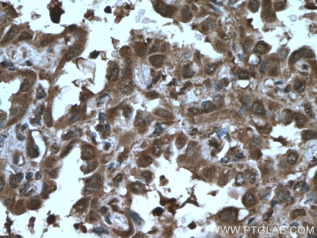 Immunohistochemistry (IHC) staining of human lung cancer tissue using AKAP13 Polyclonal antibody (27947-1-AP)