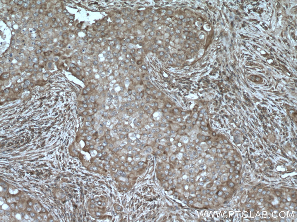 Immunohistochemistry (IHC) staining of human breast cancer tissue using AKAP13 Polyclonal antibody (27947-1-AP)