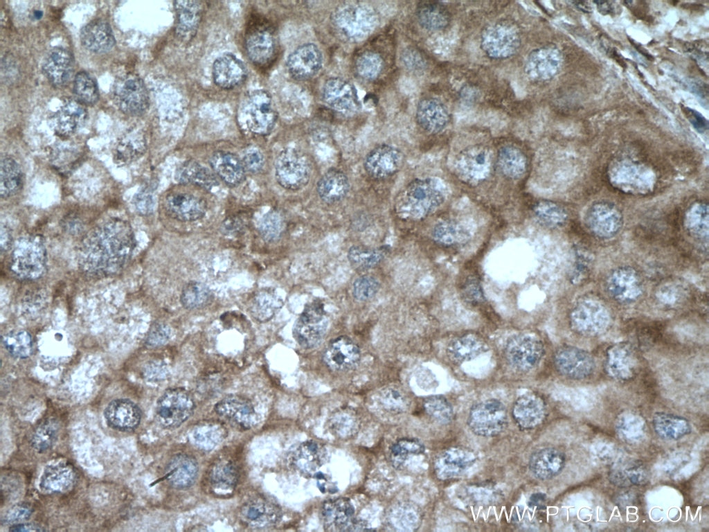 Immunohistochemistry (IHC) staining of human breast cancer tissue using AKAP13 Polyclonal antibody (27947-1-AP)