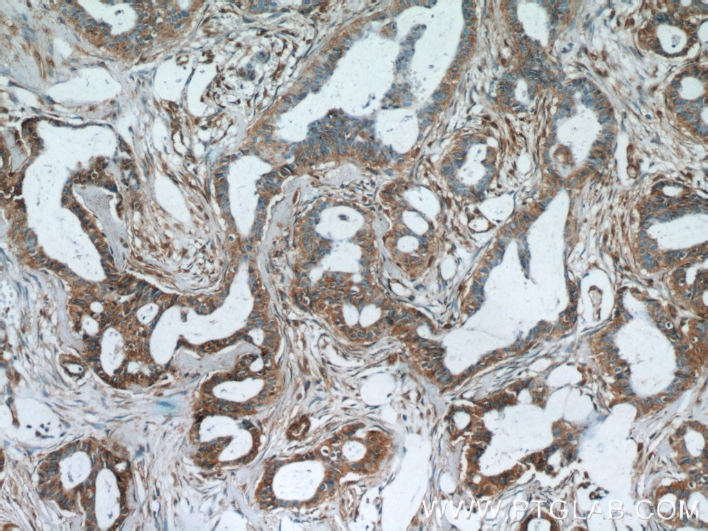 Immunohistochemistry (IHC) staining of human breast cancer tissue using AKAP4 Polyclonal antibody (24986-1-AP)