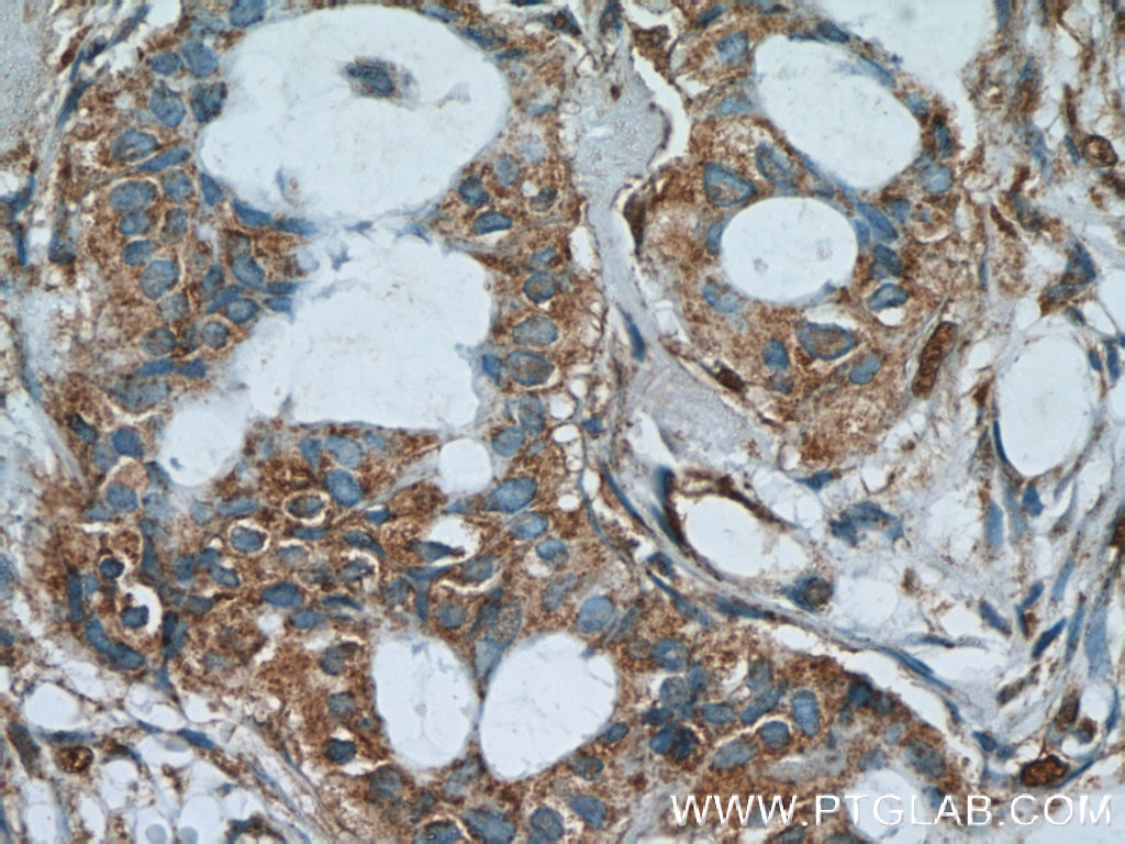 Immunohistochemistry (IHC) staining of human breast cancer tissue using AKAP4 Polyclonal antibody (24986-1-AP)